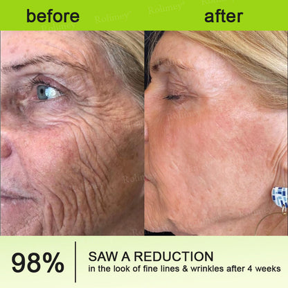 👩‍⚕️Made and shipped from the USA 💫Rolimey® Botox & Vita-A Retinol Shot Wrinkle-Lift Tightening cream - Last Day Promotion 70% OFF