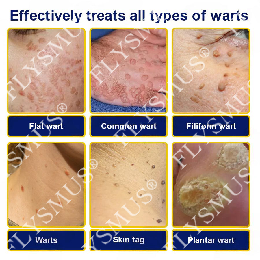FLYSMUS® SKIN TAG CRYO TREATMENT SPRAY ACE